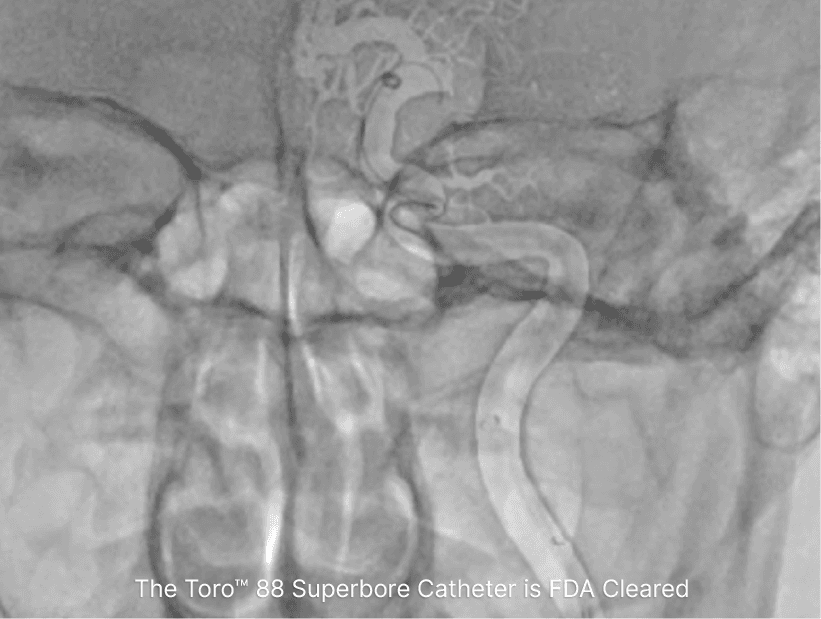 Toro Neurovascular, Inc. hero photo